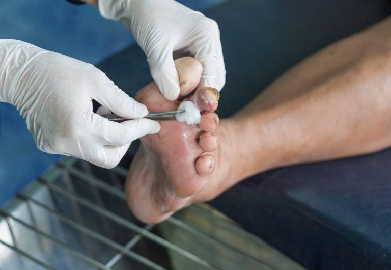 Immagine di un piede diabetico che mostra segni di ulcere e alterazioni cutanee