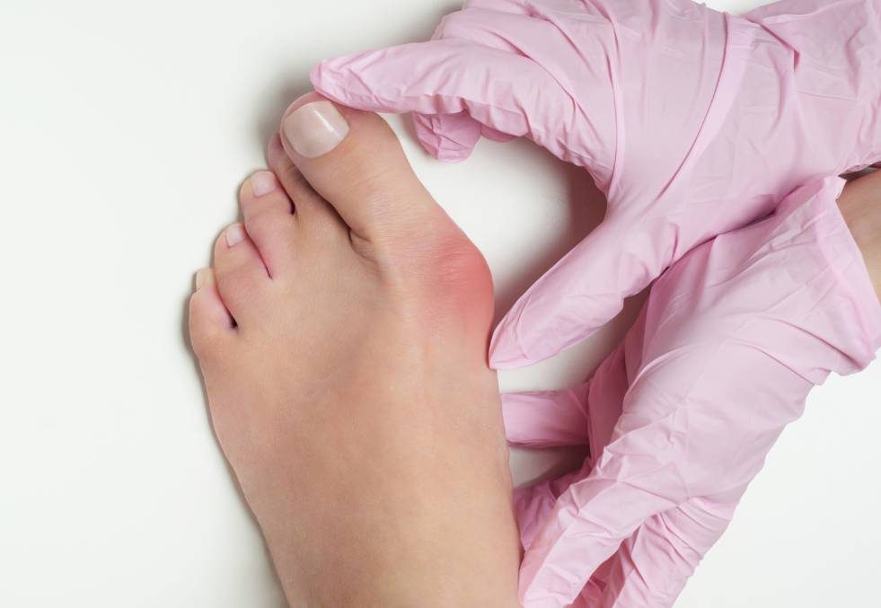 Piede di una donna con alluce valgo, evidenziando la deviazione dell'alluce