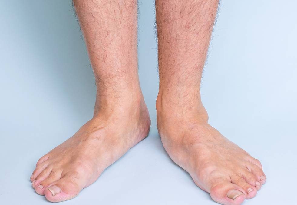Due piedi piatti di un uomo, evidenziando la condizione del piede piatto
